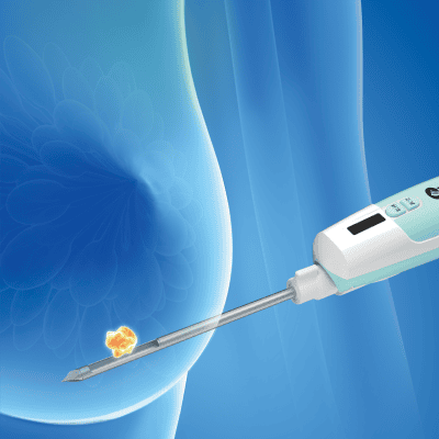 Kim sinh thiết vú chân không