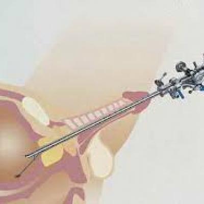 Bộ Dụng Cụ Xẻ Hẹp Niệu Đạo