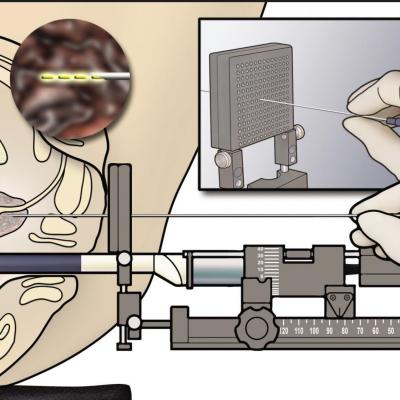 Gá sinh thiết và điều trị U xơ Tiền liệt tuyến đặt hạt phóng xạ